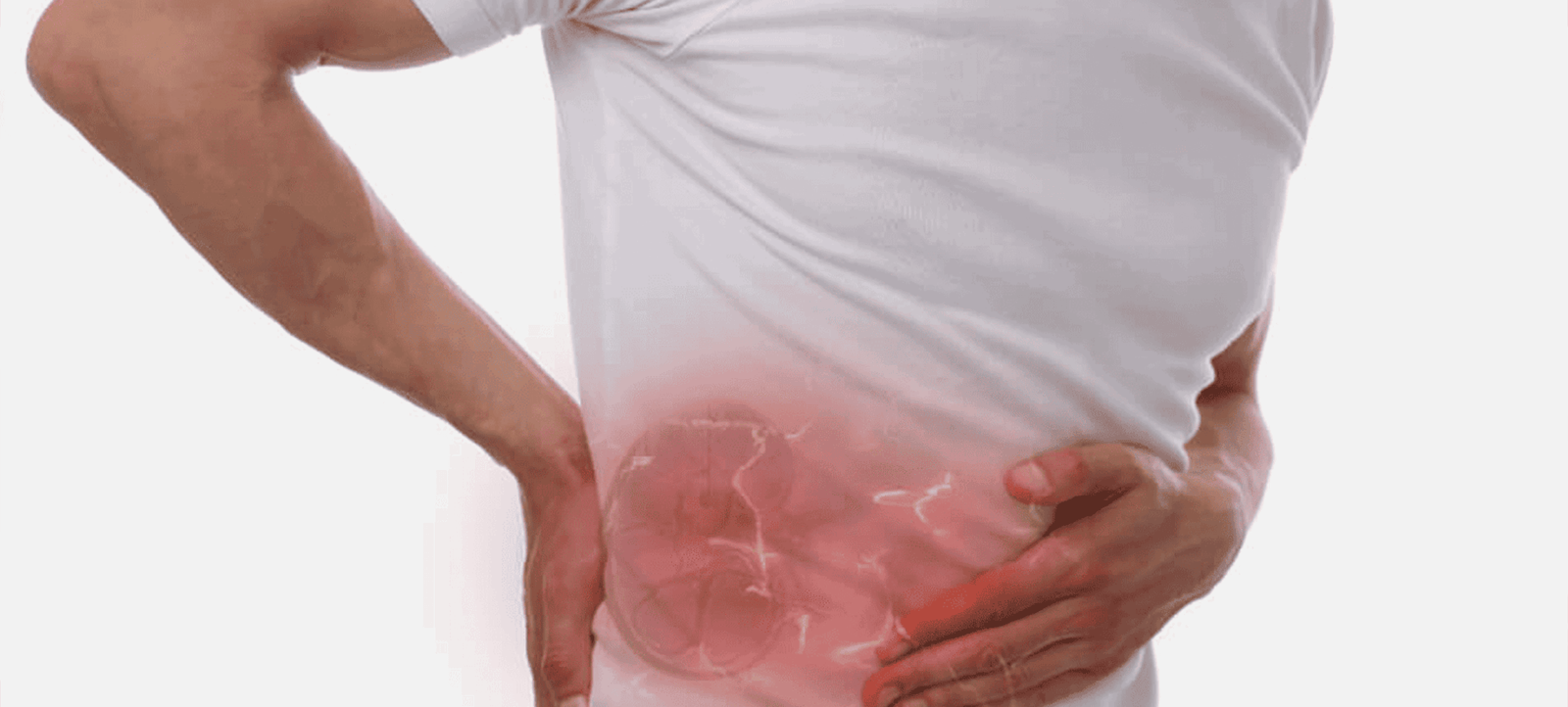 What are the first signs of kidney stones